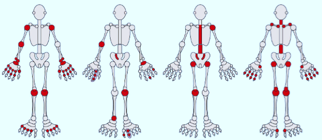 From left to right: Rheumatoid affecting MCP, PIP, MTP and other joints in a symmetrical fashion. Psoriatic arthritis affecting PIP, DIP and large joints in an asymmetrical fashion. Ankylosing spondylitis affecting the axial skeleton and large peripheral joints in an asymmetrical fashion. Osteoarthritis affecting the DIP, base of thumb, knees, hips, lumbar and cervical spine.